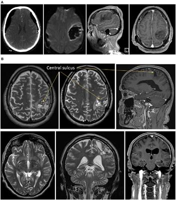 Feeling without localizing: exploring tactile misperception in a patient with uncommon parietal left brain damage